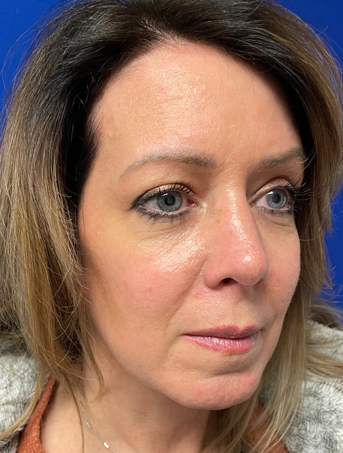 After Image: Patient Case #1991 - right-front-oblique