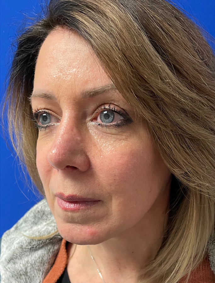 After Image: Patient Case #1991 - left-front-oblique