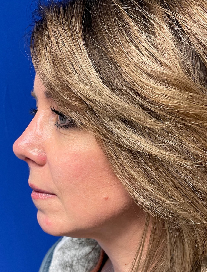 After Image: Patient Case #1991 - left-side