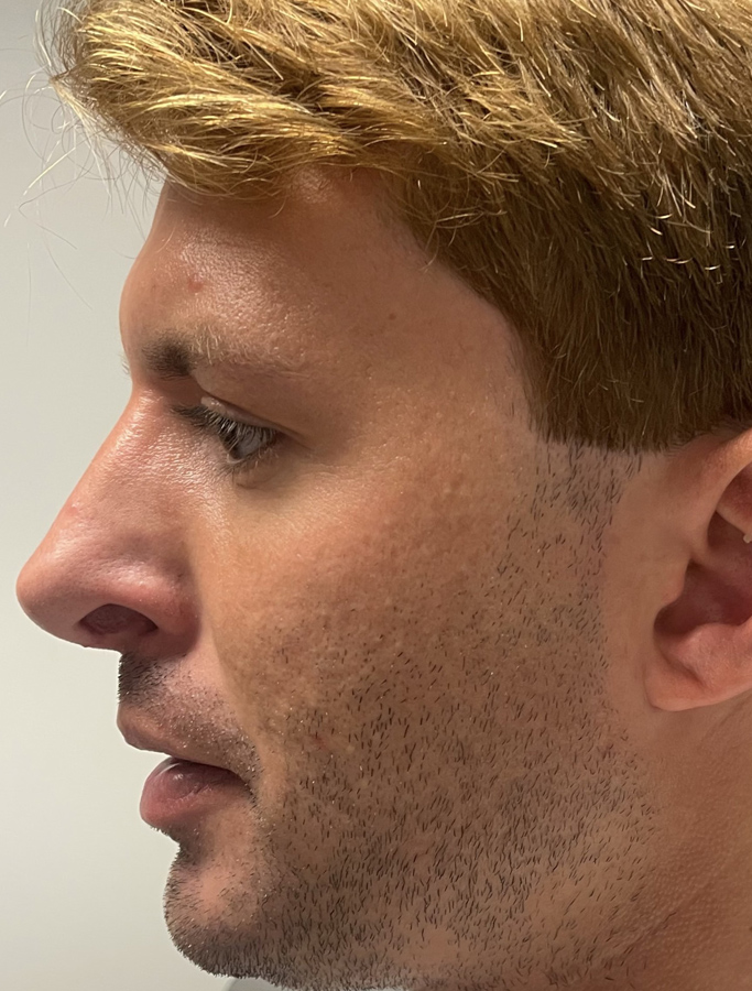 After Image: Patient Case #1992 - left-side