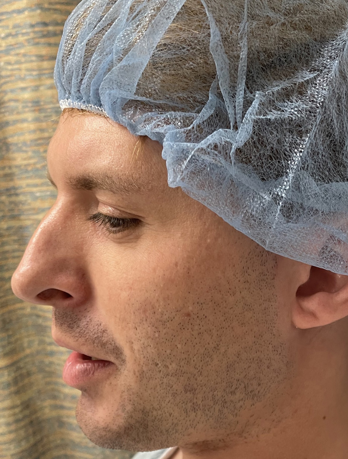 Before Image: Patient Case #1992 - left-side