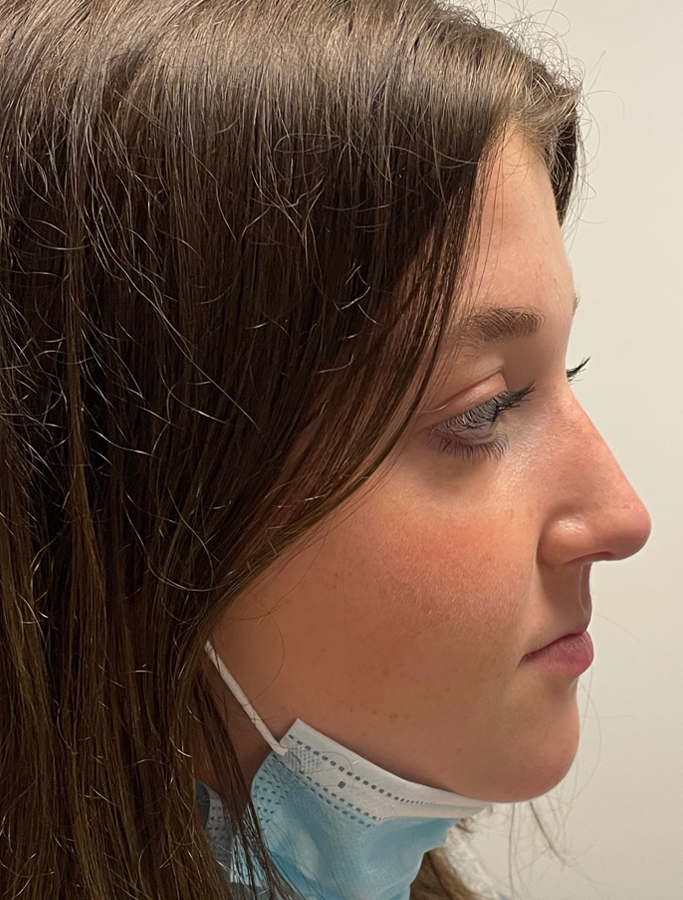 After Image: Patient Case #1993 - right-side