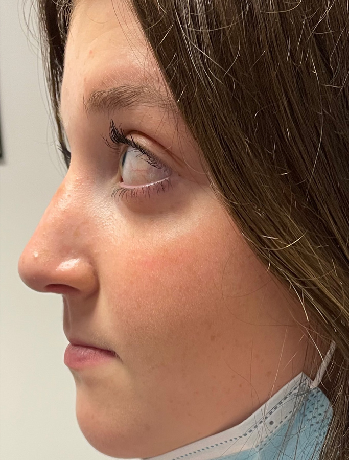 After Image: Patient Case #1993 - left-side