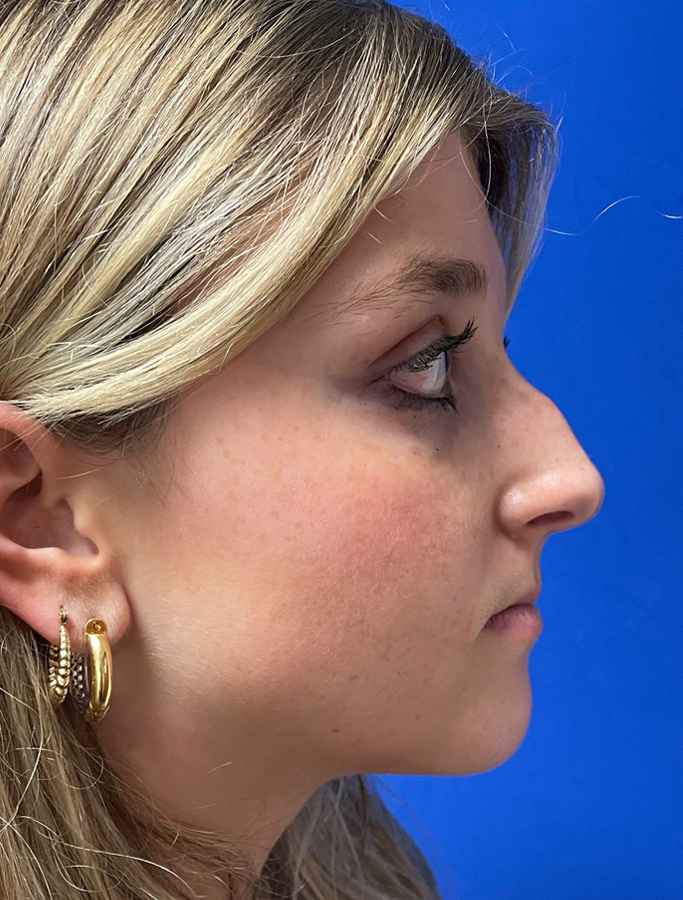 Before Image: Patient Case #1993 - right-side