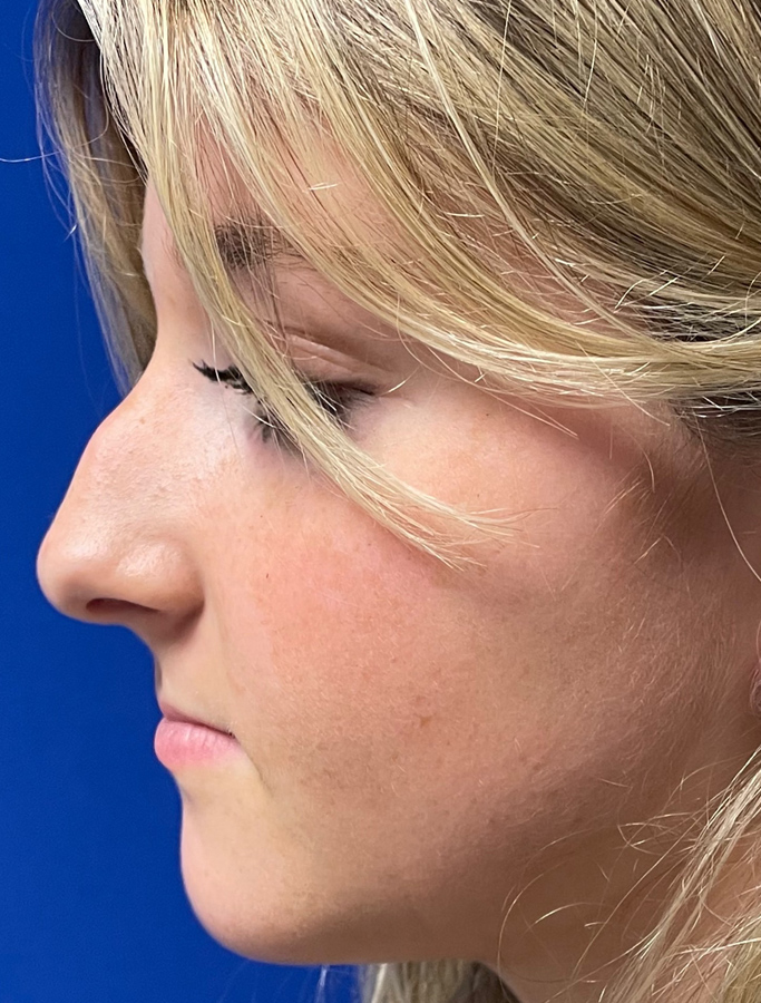 Before Image: Patient Case #1993 - left-side