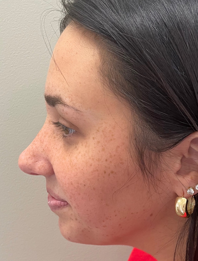 After Image: Patient Case #1994 - left-side