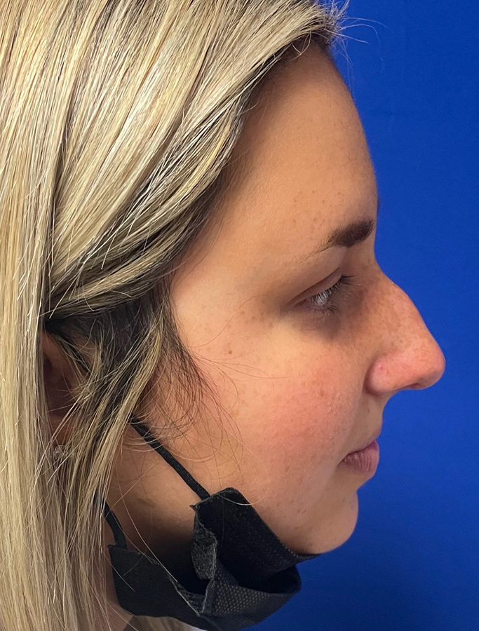 Before Image: Patient Case #1994 - right-side