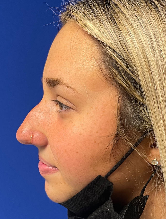 Before Image: Patient Case #1994 - left-side