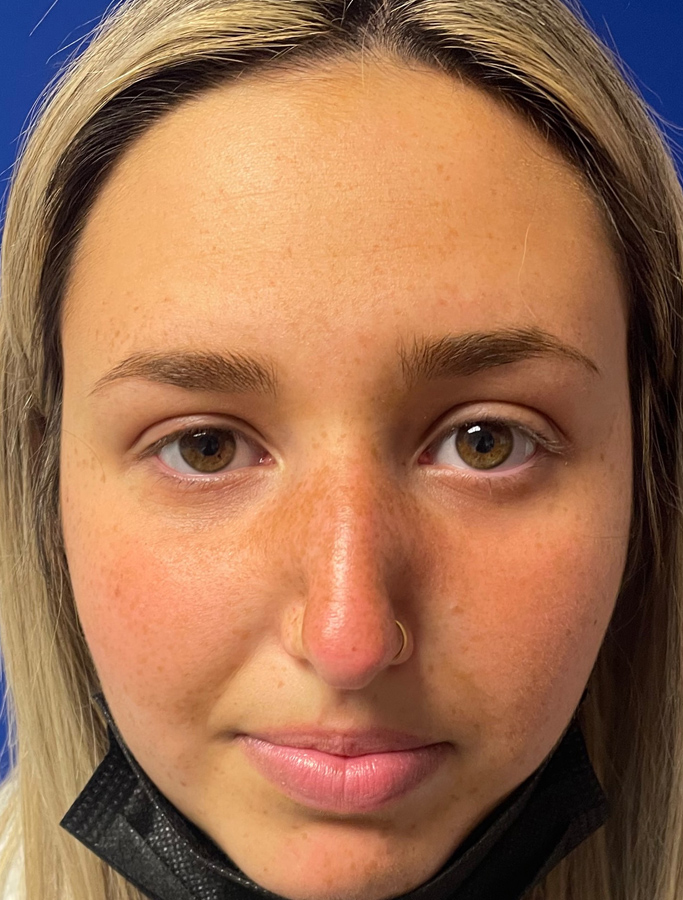 Before Image: Patient Case #1994 - front