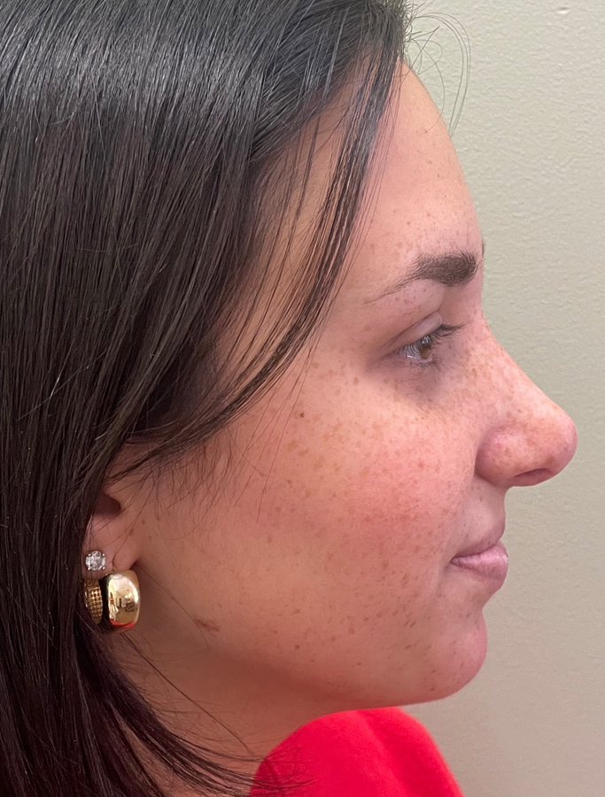 After Image: Patient Case #1994 - right-side