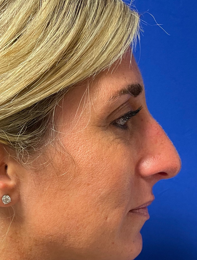 Before Image: Patient Case #1996 - right-side