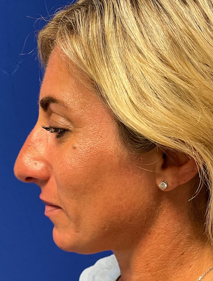 Before Image: Patient Case #1996 - left-side