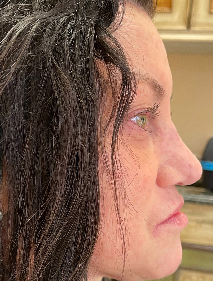 After Image: Patient Case #2031 - right-side