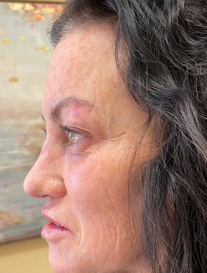 After Image: Patient Case #2031 - left-side