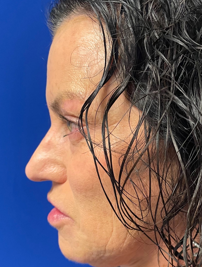 Before Image: Patient Case #2031 - left-side