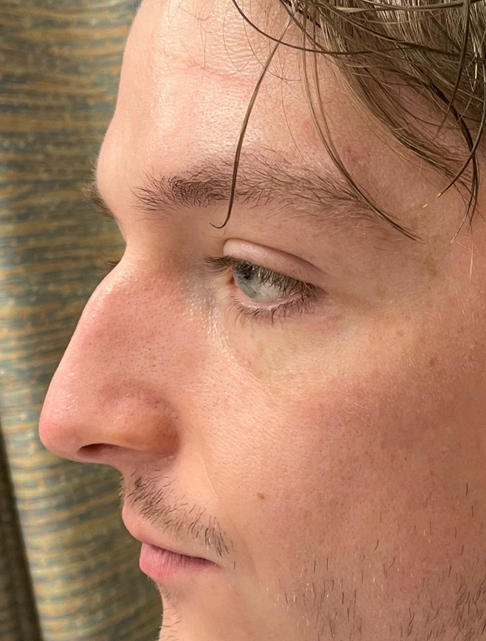 Before Image: Patient Case #2033 - left-side