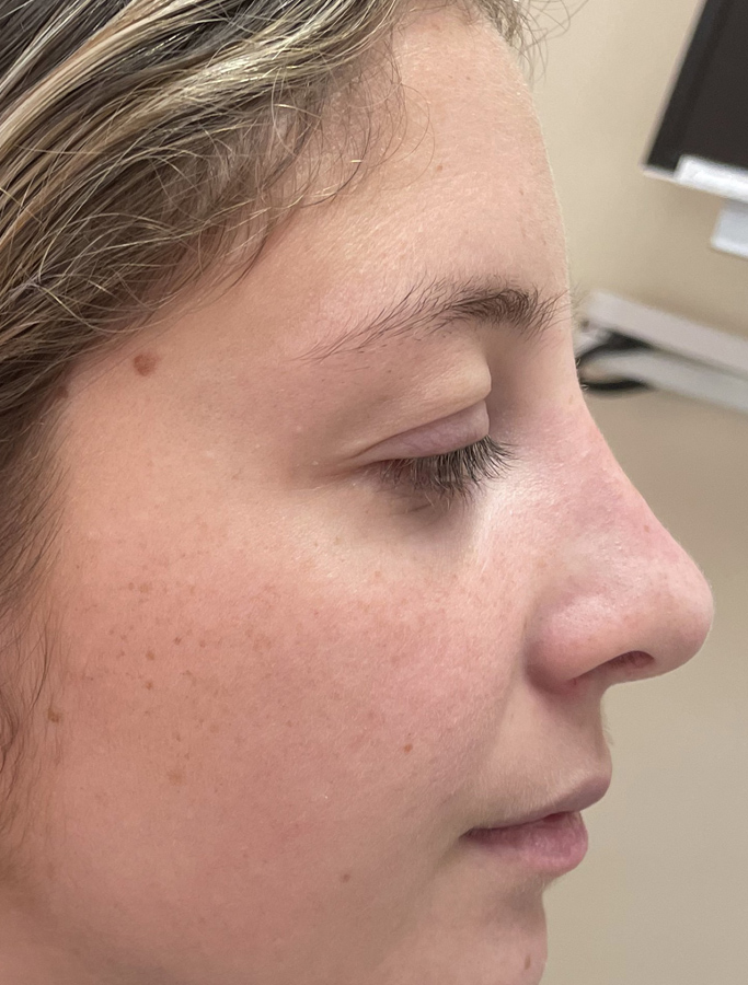 After Image: Patient Case #2034 - right-side