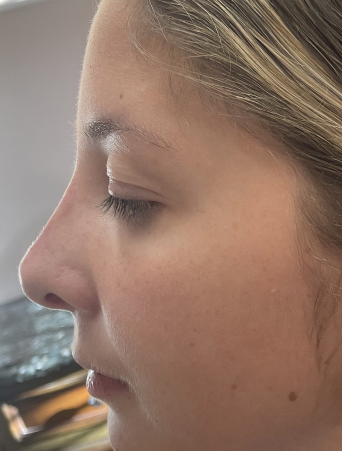 After Image: Patient Case #2034 - left-side