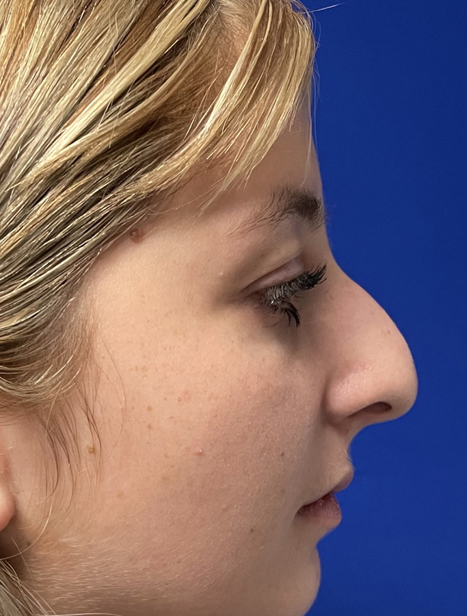 Before Image: Patient Case #2034 - right-side