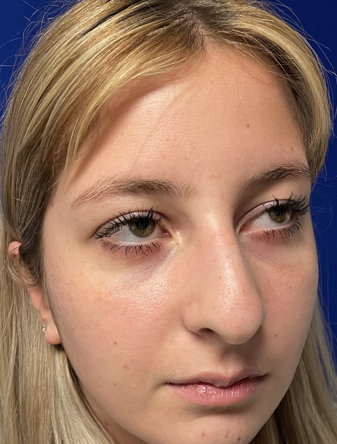 Before Image: Patient Case #2034 - right-front-oblique