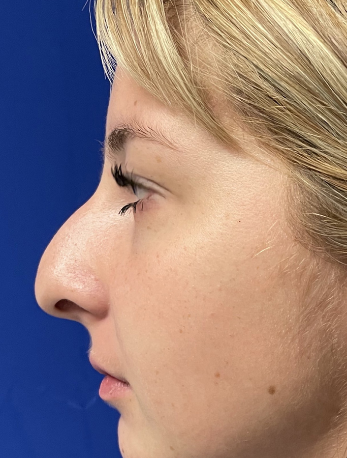 Before Image: Patient Case #2034 - left-side