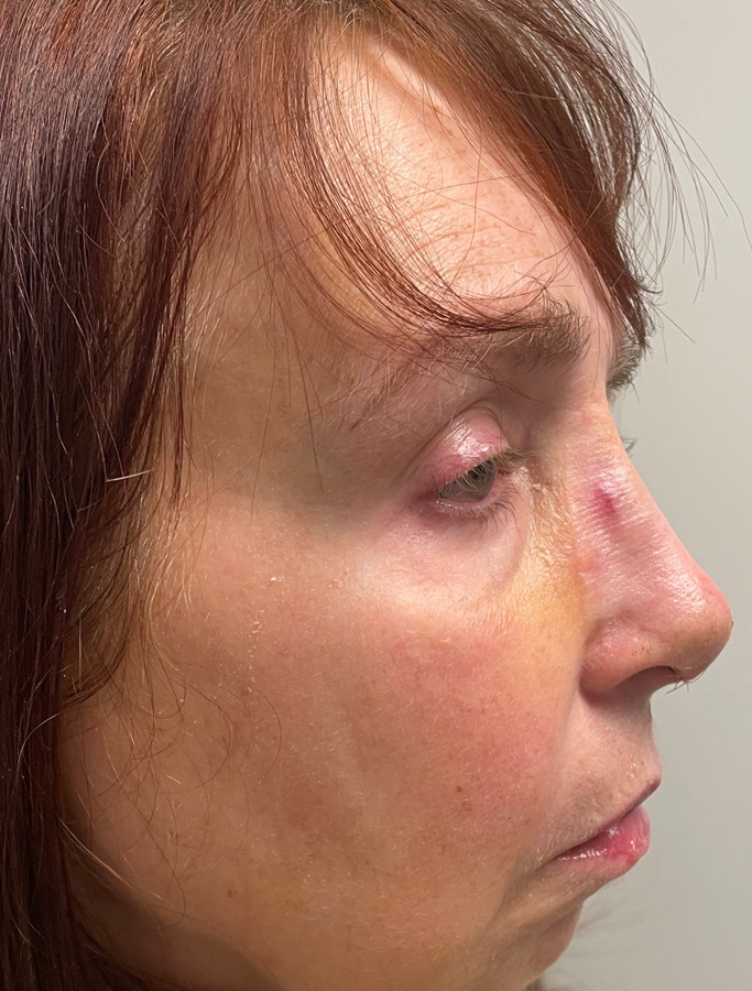 After Image: Patient Case #2035 - right-side