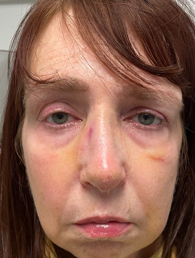 After Image: Patient Case #2035 - front