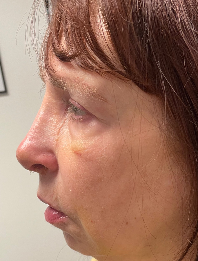 After Image: Patient Case #2035 - left-side