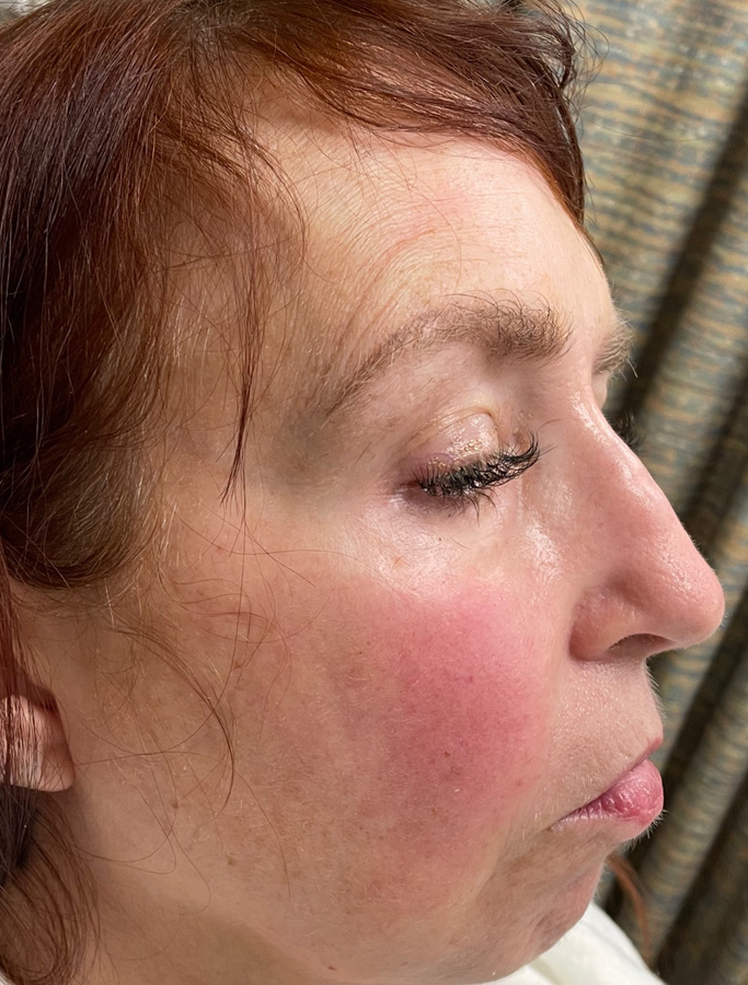 Before Image: Patient Case #2035 - right-side