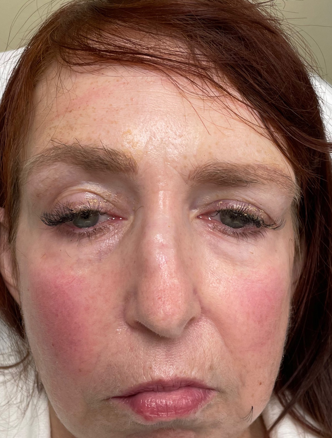 Before Image: Patient Case #2035 - front