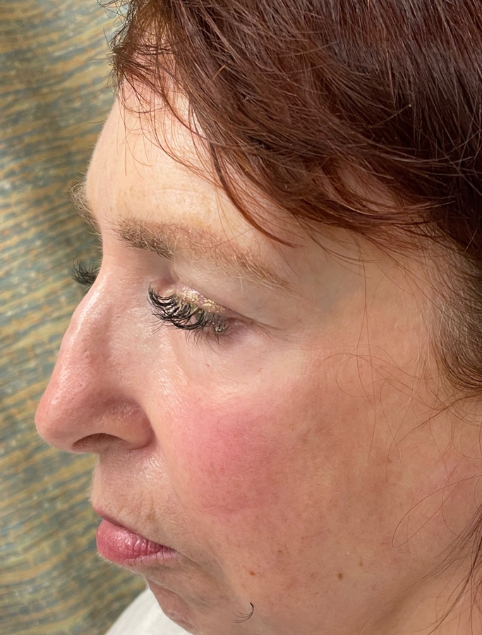 Before Image: Patient Case #2035 - left-side