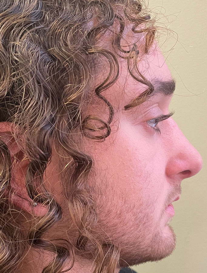 After Image: Patient Case #2066 - right-side