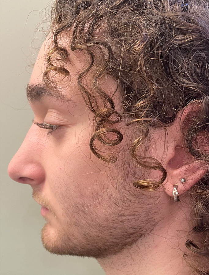 After Image: Patient Case #2066 - left-side