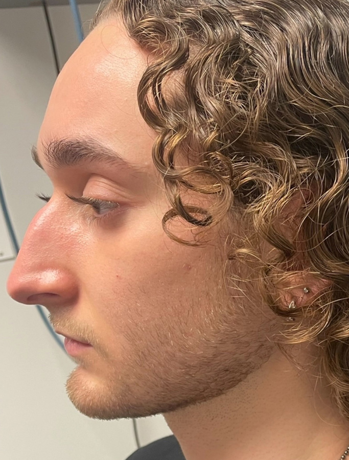 Before Image: Patient Case #2066 - left-side