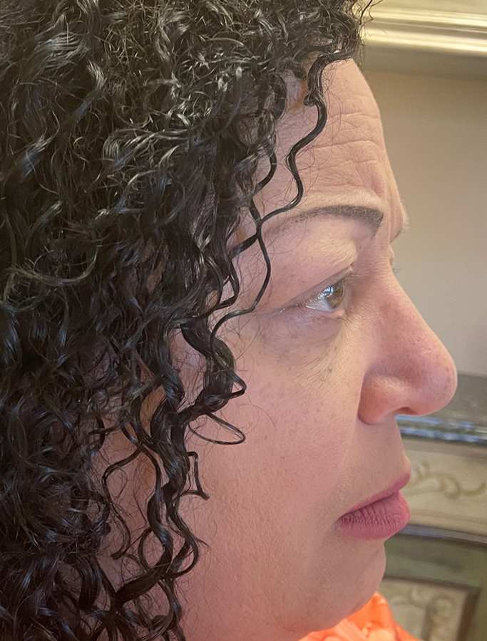 After Image: Patient Case #2067 - right-side