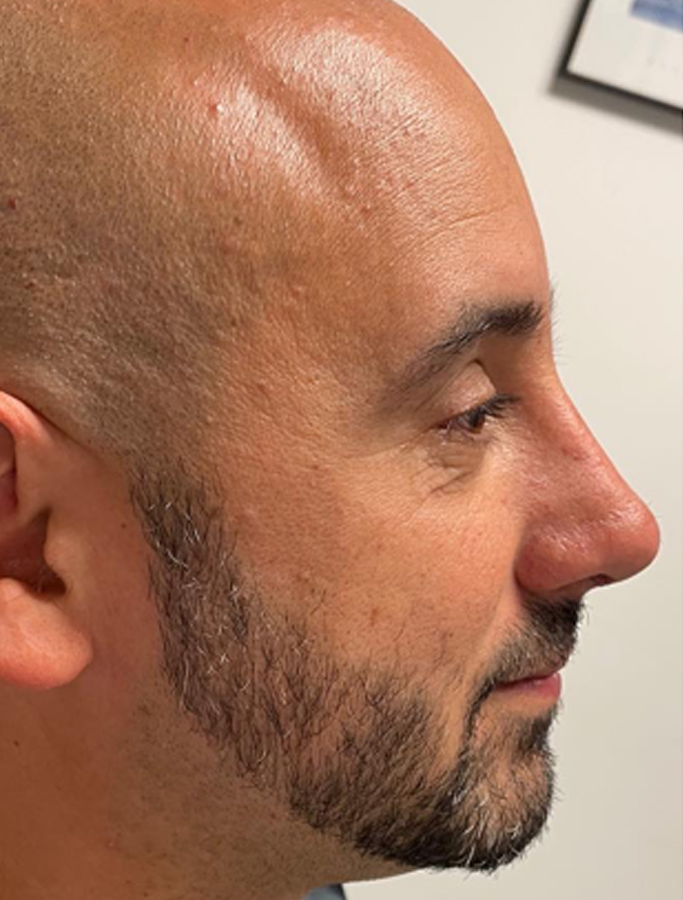 After Image: Patient Case #2068 - right-side