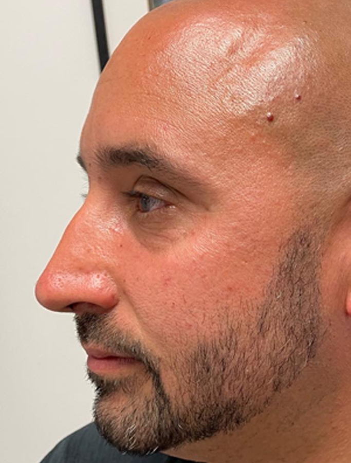 Before Image: Patient Case #2068 - left-side