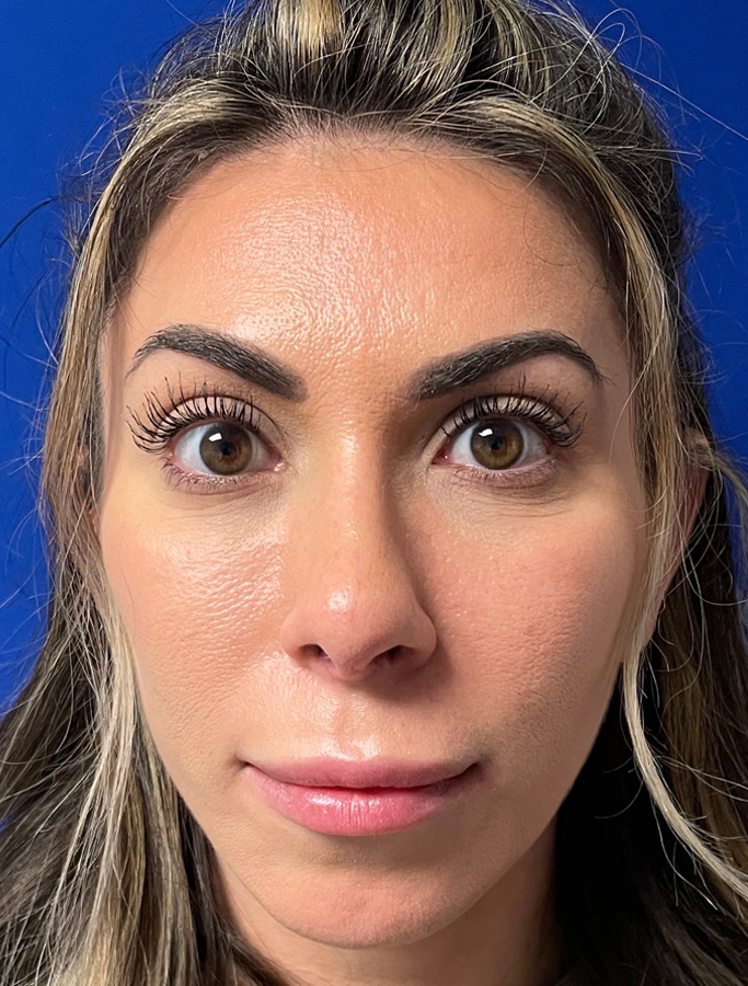 After Image: Patient Case #2069 - front