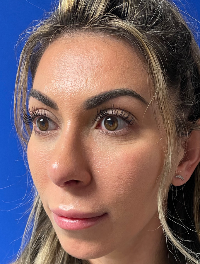 After Image: Patient Case #2069 - left-front-oblique