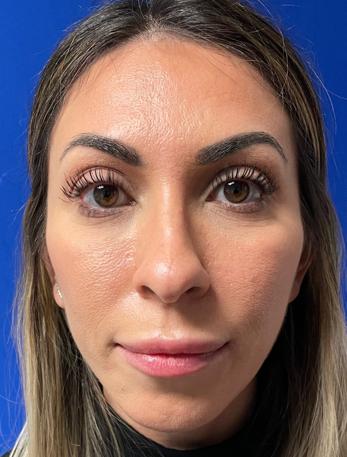 Before Image: Patient Case #2069 - front