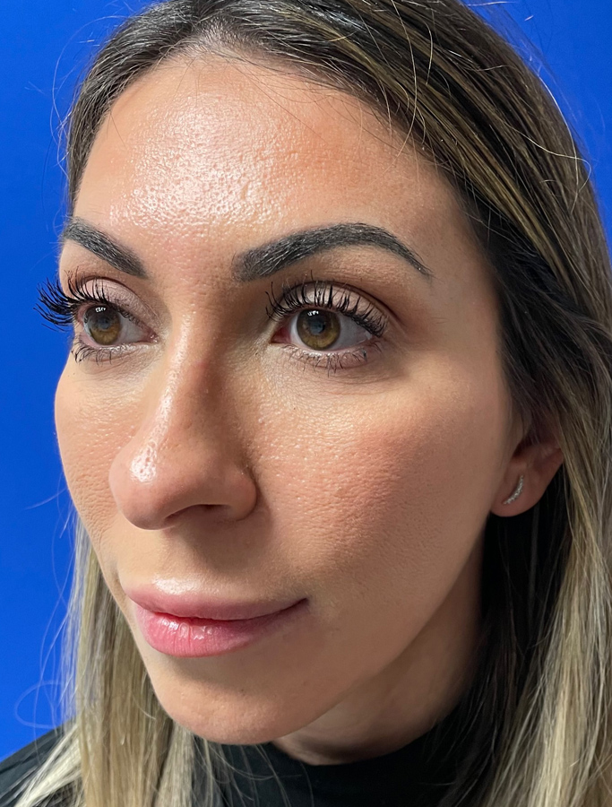 Before Image: Patient Case #2069 - left-front-oblique