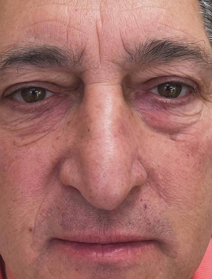 After Image: Patient Case #1699 - front