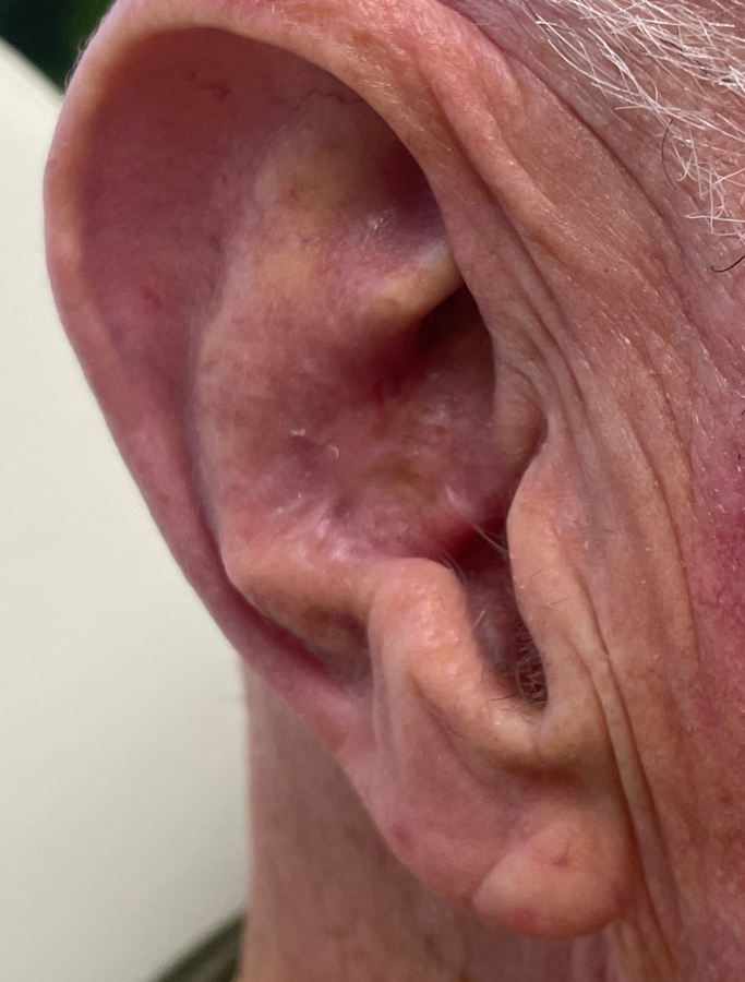 After Image: Patient Case #1716 - right-side