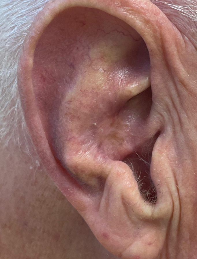 After Image: Patient Case #1716 - right-side