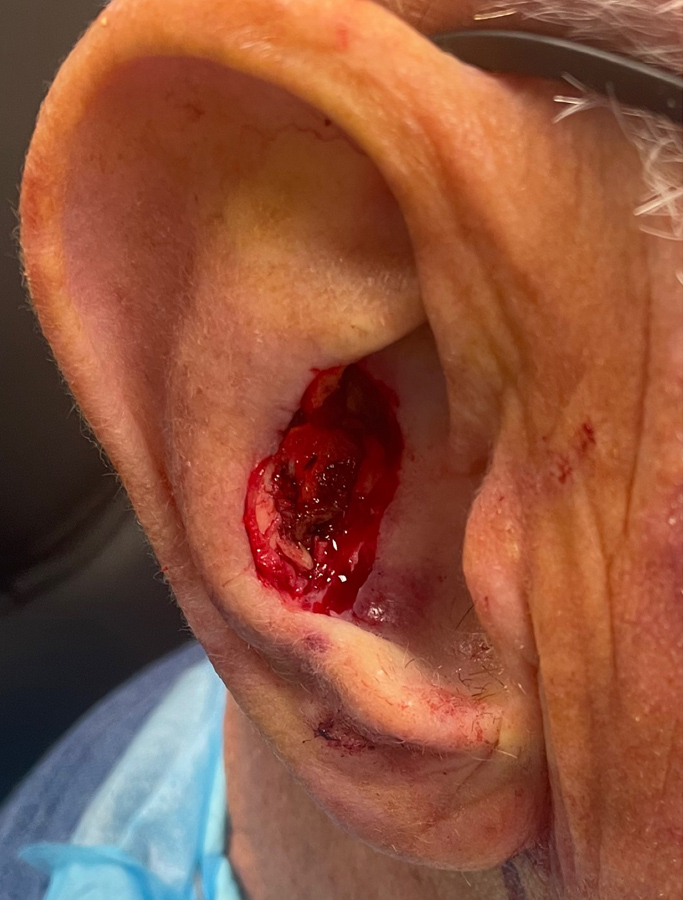 Before Image: Patient Case #1716 - right-side