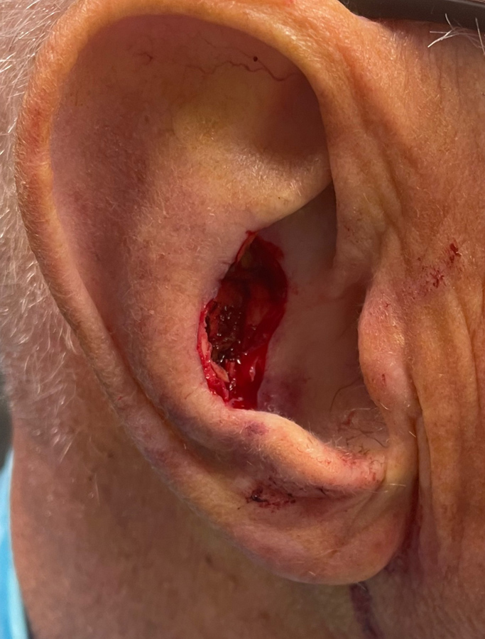 Before Image: Patient Case #1716 - right-side