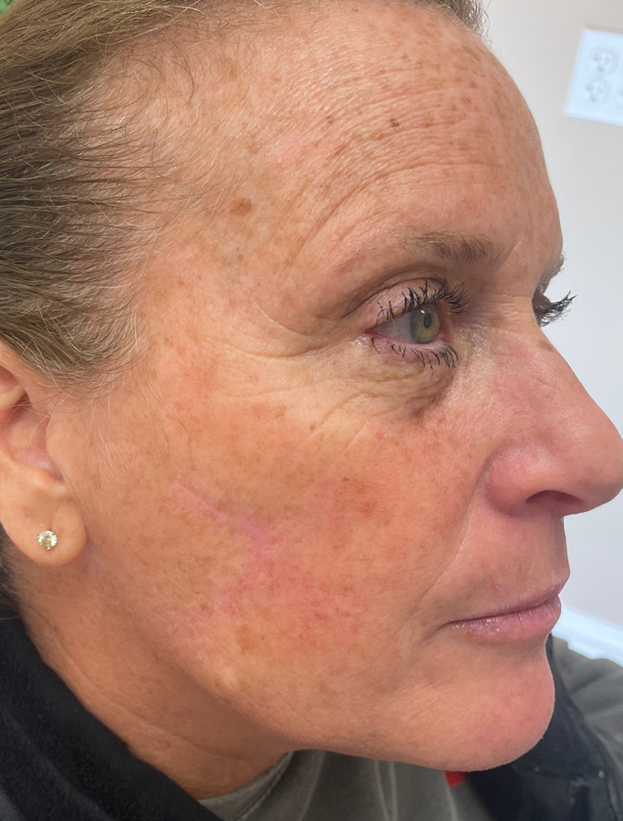 After Image: Patient Case #1719 - right-side