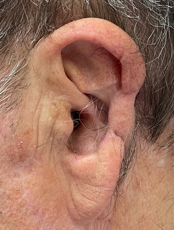 After Image: Patient Case #1721 - left-side