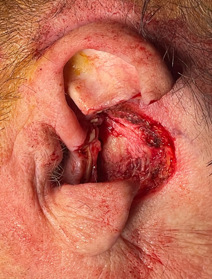 Before Image: Patient Case #1721 - left-side