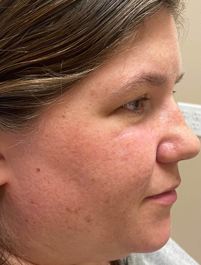 After Image: Patient Case #17941 - right-side